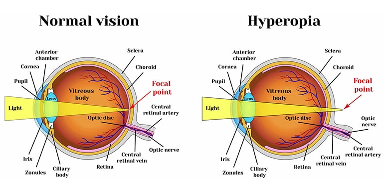 normal vision and hyperopia